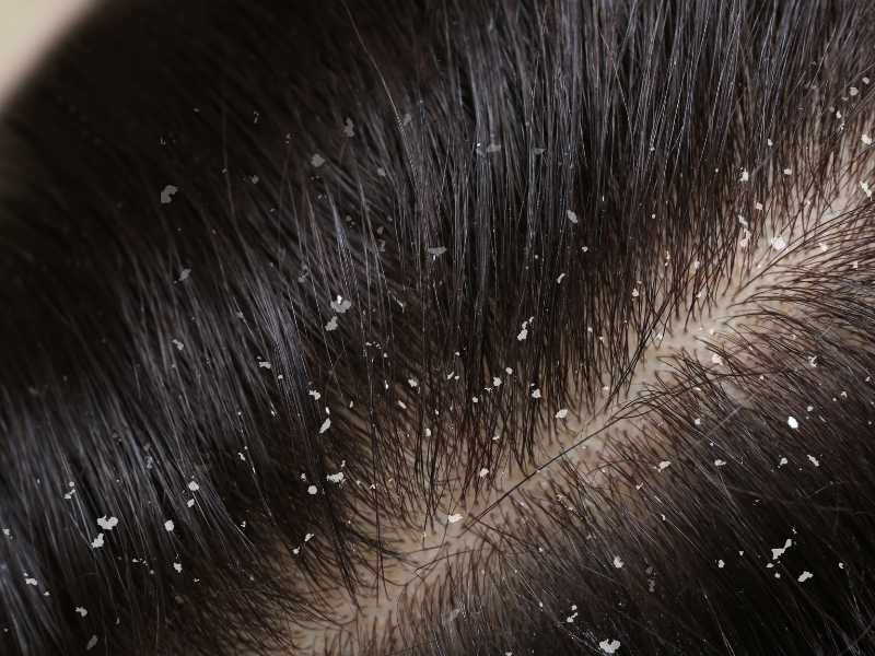 How-to-Get-Rid-of-Dandruff